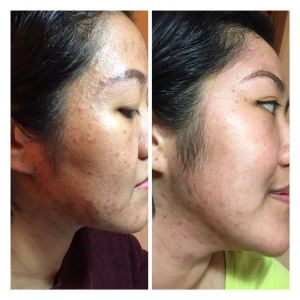 DemiKinclong2016 Before After Bebas Jerawat - Muka saya dari sebelah kanan